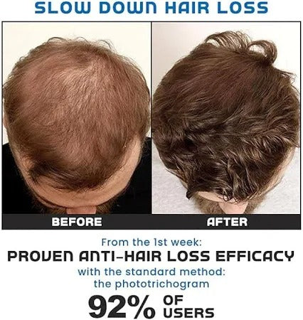 Minoxi Roll-On Hair Treatment Hair Growth Serum