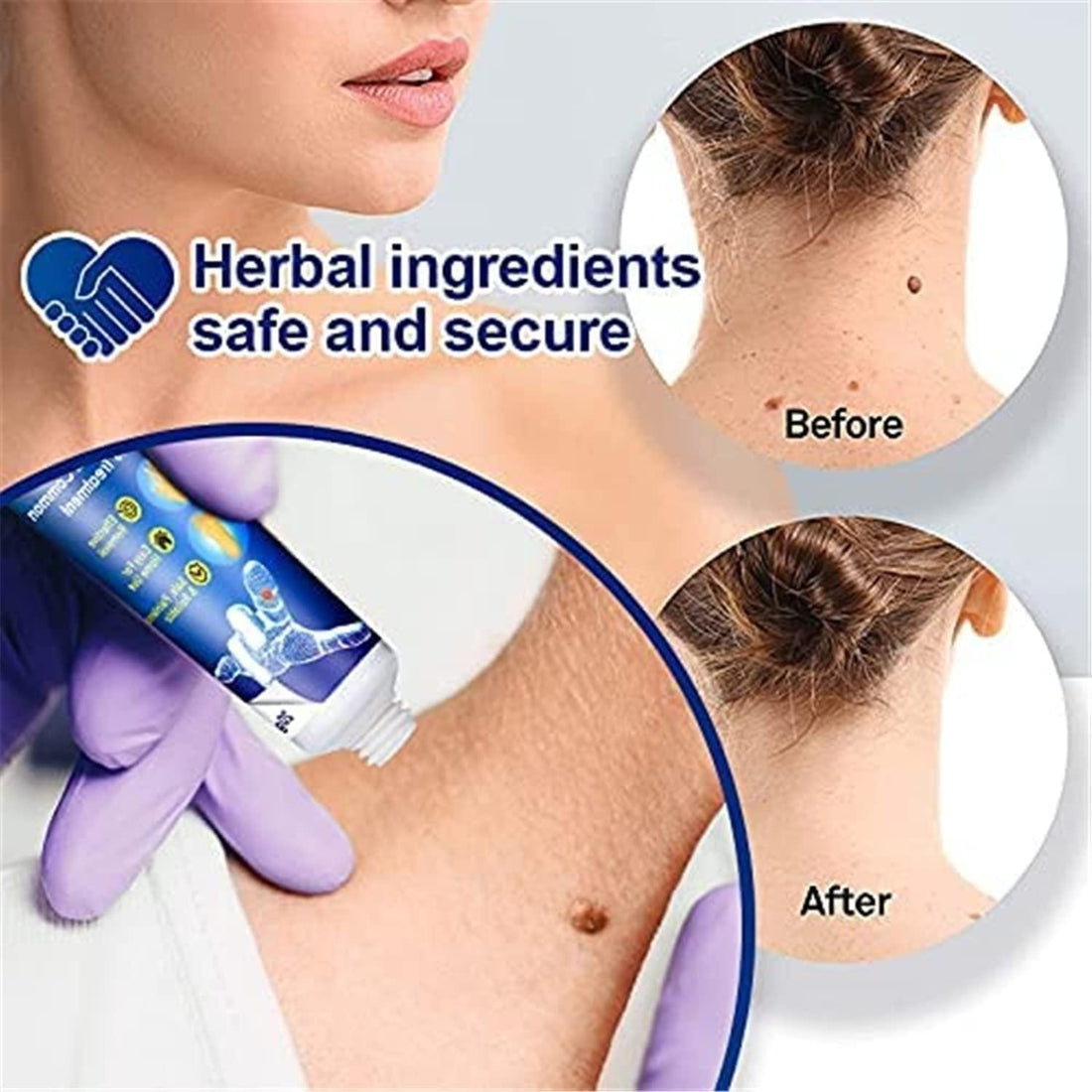 Premium Wart Remover Ointment for All Skin Types